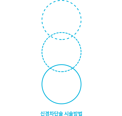 신경차단술 시술방법